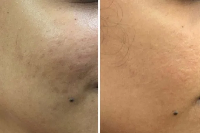 Open Pores Result